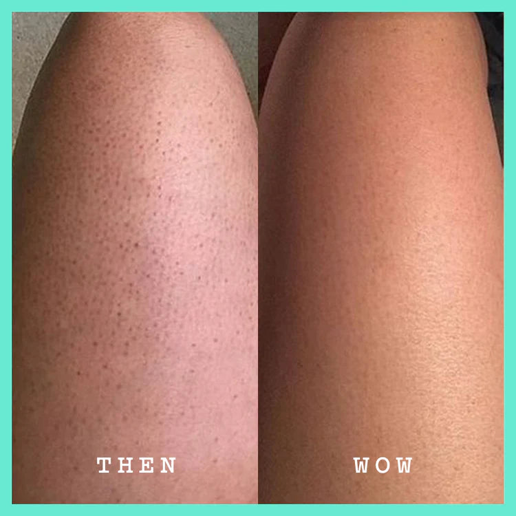 Vorher-Nachher-Vergleich mit FRANK BODY Glycolic Body Scrub: Links Haut mit dunklen Poren, rechts glatte Haut