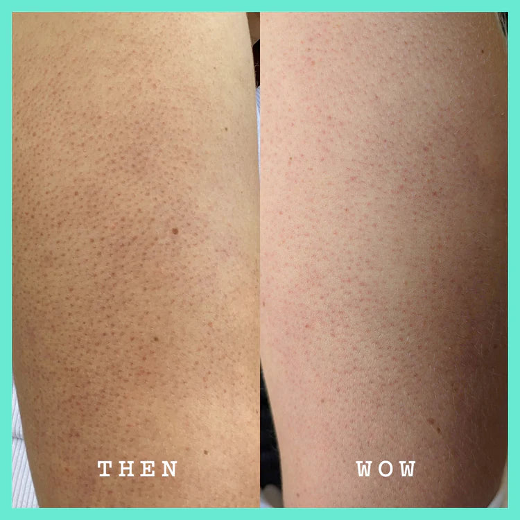 Vorher-Nachher-Vergleich zeigt reduzierte Erdbeerhaut nach der Anwendung von FRANK BODY Glycolic Body Scrub