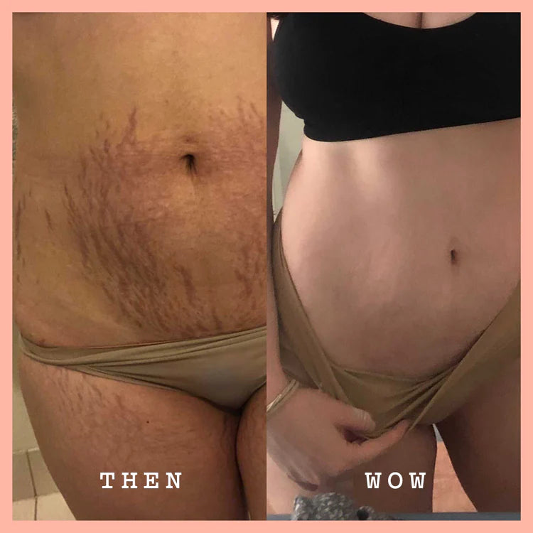 Vorher-Nachher-Vergleich von Dehnungsstreifen am Bauch mit FRANK BODY Original Coffee Scrub (ON-THE-GO) 100g