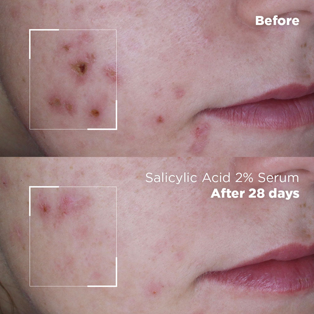Nahaufnahme der Haut vor und nach 28 Tagen der Anwendung des Salicylsäure-Serums, die einen Rückgang der Akne und eine klarere Haut zeigt. Ein weißes Quadrat hebt einen betroffenen Bereich in jedem Bild hervor.
