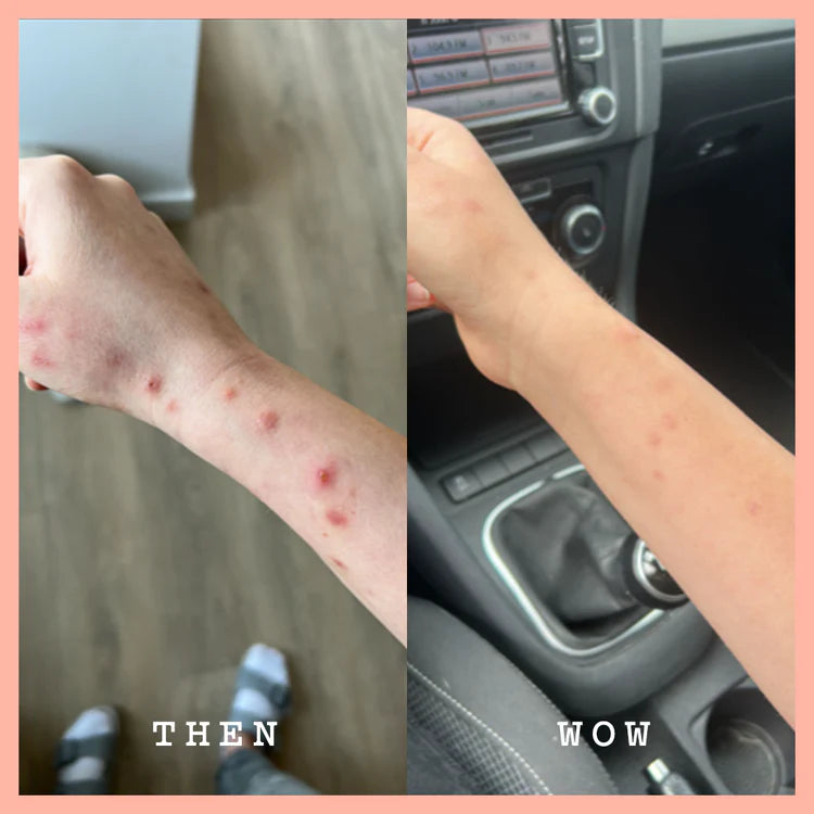 Vorher-Nachher-Vergleich: Abgeheilte Hautunreinheiten am Arm nach Nutzung von FRANK BODY Original Coffee Scrub