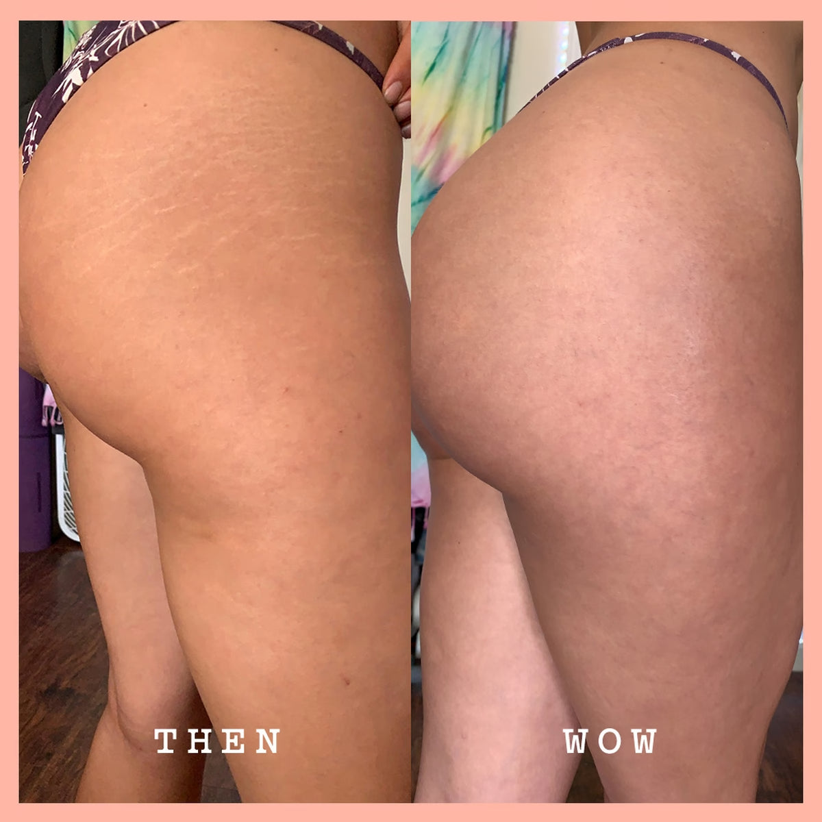 Vorher-Nachher-Vergleich am Gesäss: Glattere Haut und reduzierte Dehnungsstreifen dank FRANK BODY Rosehip Body Scrub
