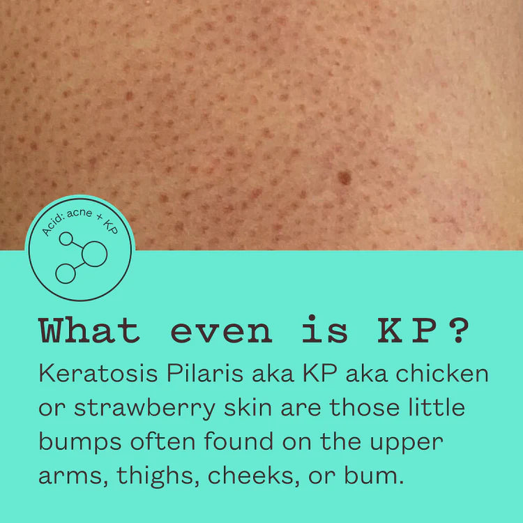 FRANK BODY Infografik zu Keratosis Pilaris (Reibeisenhaut) mit Nahaufnahme von Erdbeerhaut und Erklärungstext