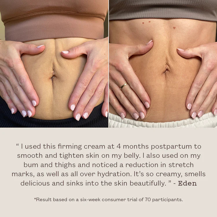 Vorher-Nachher-Vergleich der FRANK BODY Firming Body Cream 230ml an der Bauchhaut mit postpartum Erfahrungsbericht