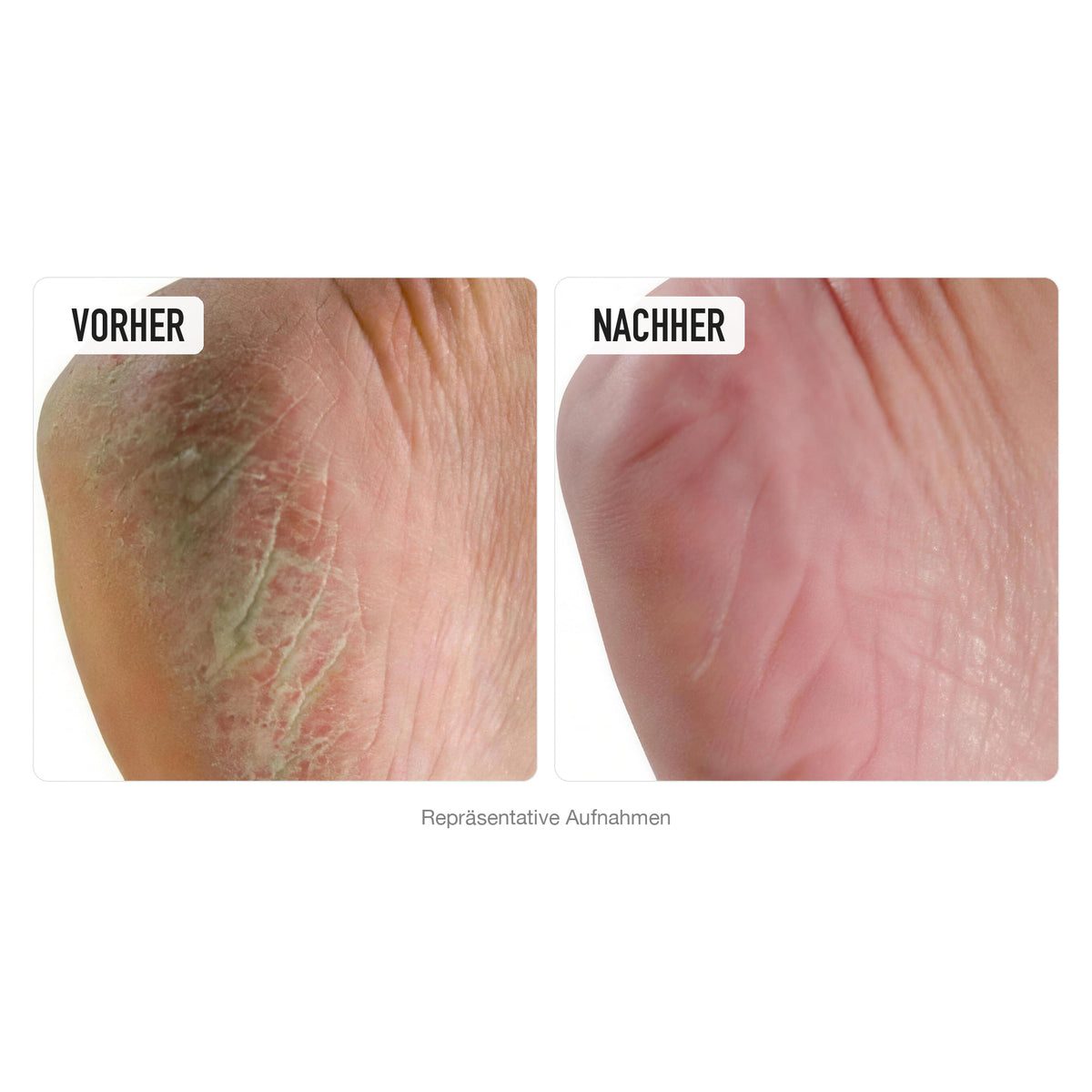Ferse vorher und nachher, repräsentative Aufnahmen zu O'KEEFFE'S Healthy Feet Fusscreme