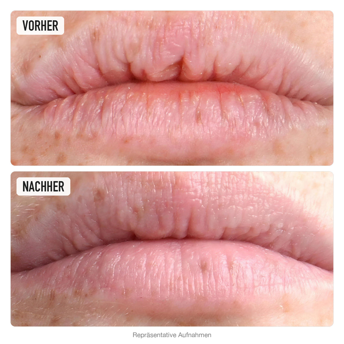 Lippen vorher und nachher, repräsentative Aufnahmen zu O'KEEFFE'S Lip Repair Cherry
