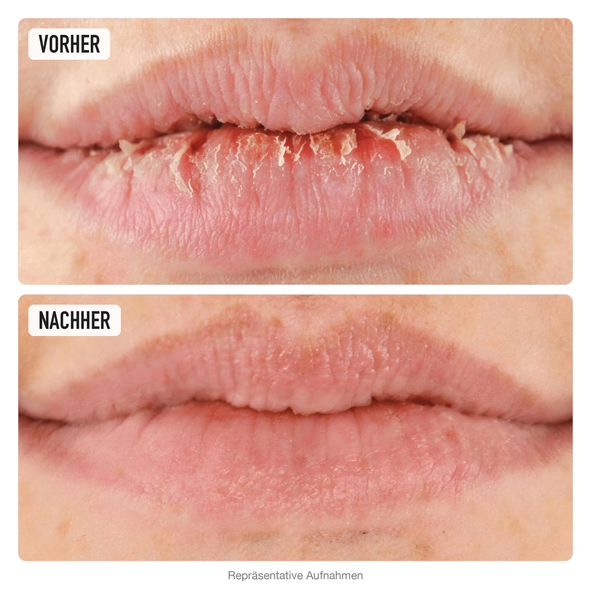 Lippen vorher und nachher, repräsentative Aufnahmen zu O'KEEFFE'S Lip Repair unparfümiert